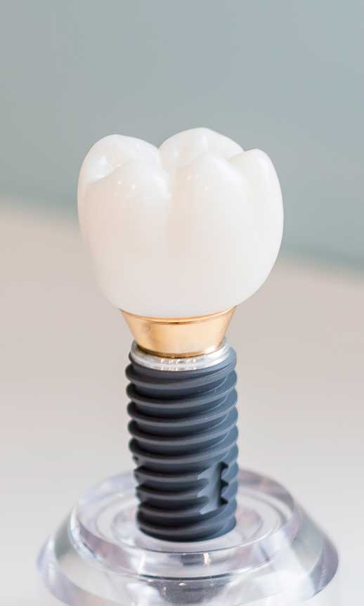 clinica-murcia-tratamiento-carillas-protesis-www.clinicamasbermejo.com