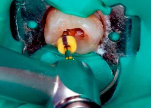 tratamiento-endodoncia-clinica-dental-mas-bermejo-dentista-www.clinicamasbermejo.com
