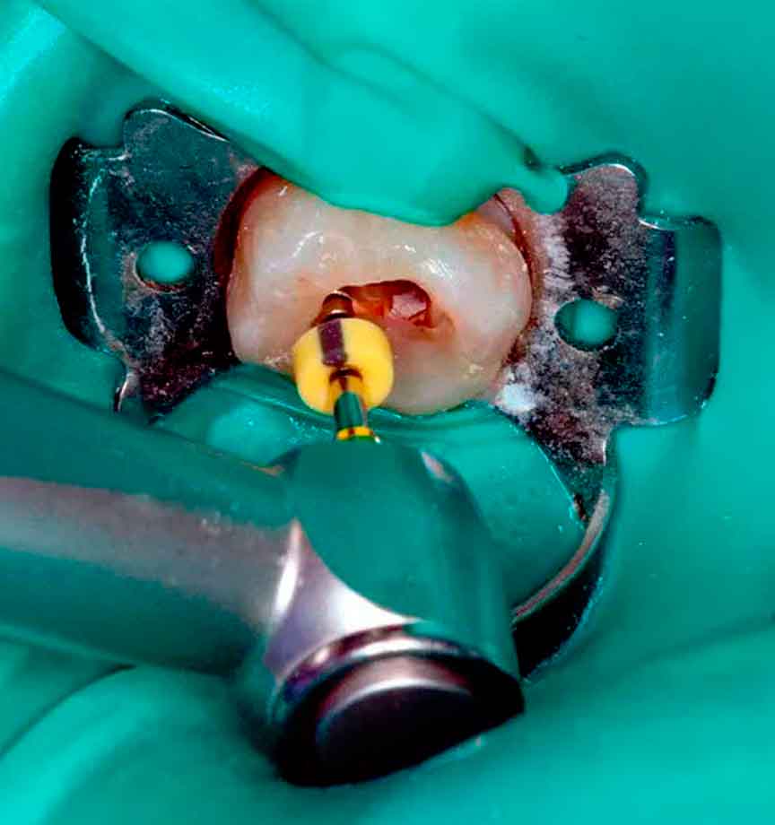 tratamiento-endodoncia-clinica-dental-mas-bermejo-dentista-www.clinicamasbermejo.com tratamiento-endodoncia-clinica-dental-mas-bermejo-dentista-www.clinicamasbermejo.com