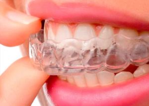 tratamiento-invisaline-clinica-dental-mas-bermejo-dentista-www.clinicamasbermejo.com