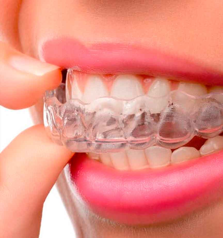 tratamiento-invisaline-clinica-dental-mas-bermejo-dentista-www.clinicamasbermejo.com
