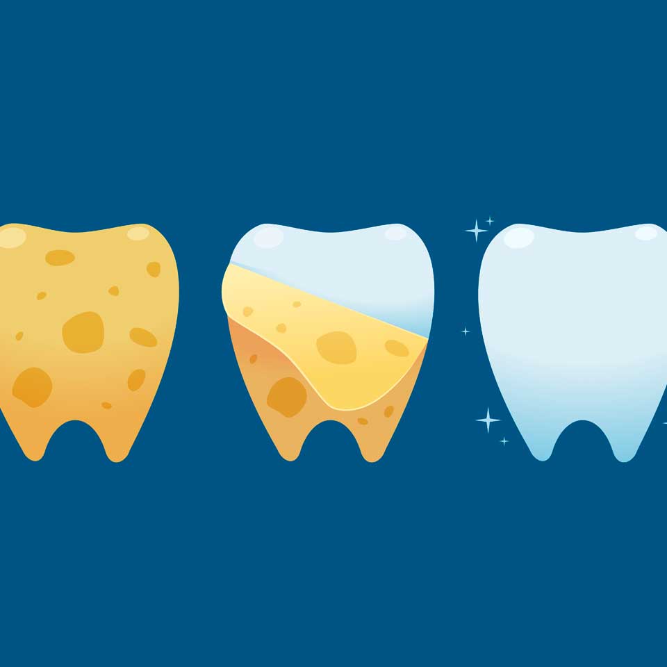 blanqueamiento-dental-www.clinicamasbermejo.com