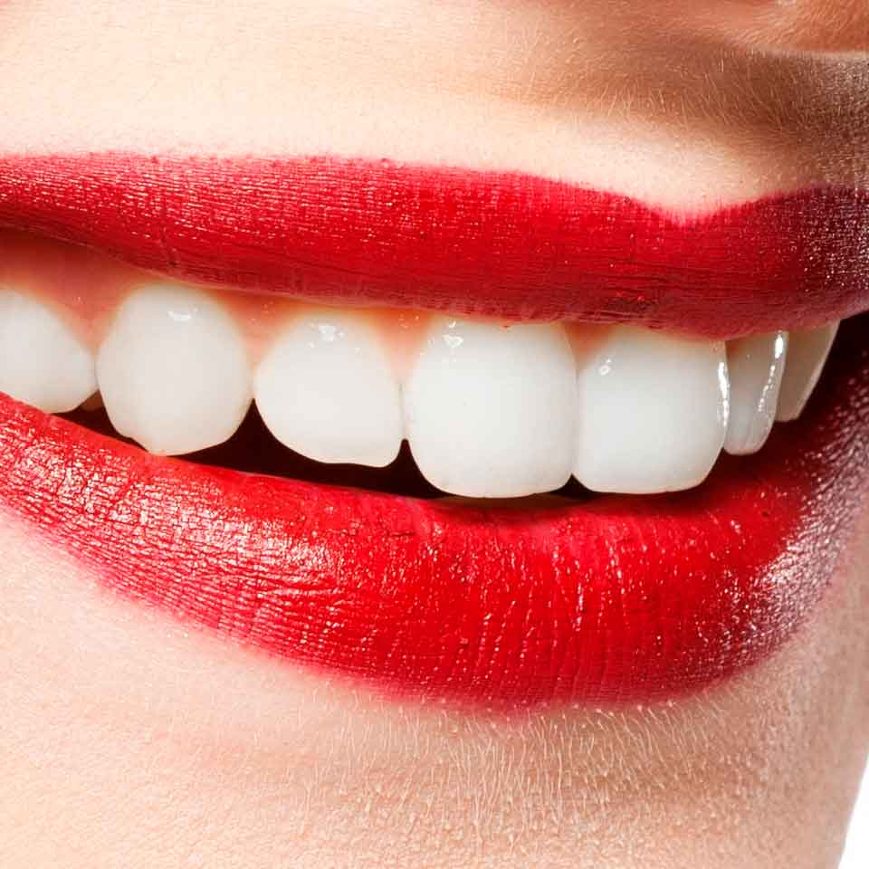 blanqueamiento-dental2-www.clinicamasbermejo.com