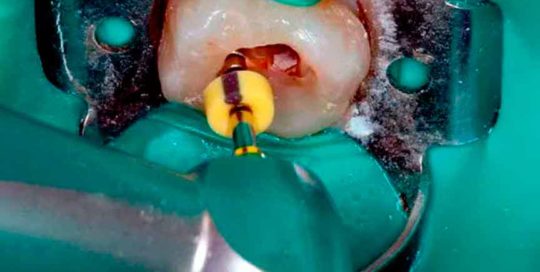 tratamiento-endodoncia-clinica-dental-mas-bermejo-dentista-www.clinicamasbermejo.com