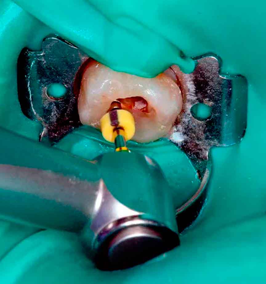 tratamiento-endodoncia-clinica-dental-mas-bermejo-dentista-www.clinicamasbermejo.com
